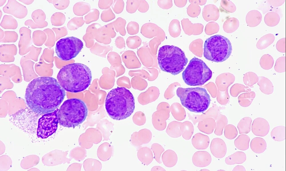 Acute Promyelocytic Leukemia, Marrow Aspirate | Ed Uthman on Flickr