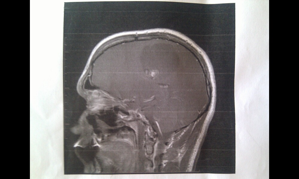 Brain tumor MRI scans | Nathanael Burton on Flickr